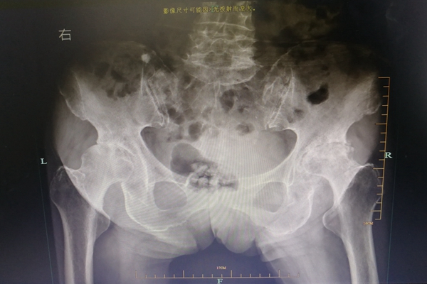 1-1手术前.jpg 1-1手术前.jpg