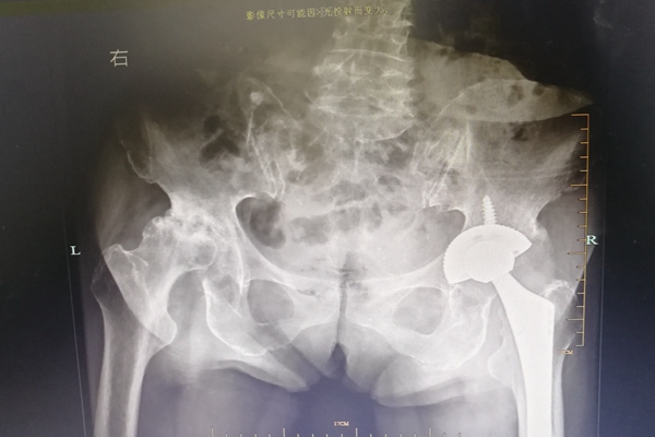 1-2第一次手术之后.jpg 1-2第一次手术之后.jpg